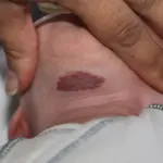 Quali potrebbero essere i fattori di rischio per gli emangiomi?