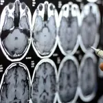 Donazione del cervello stimolata dal centro di ricerca sulla demenza di Cardiff