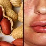 Il trattamento per l'allergia alle arachidi è promettente nello studio