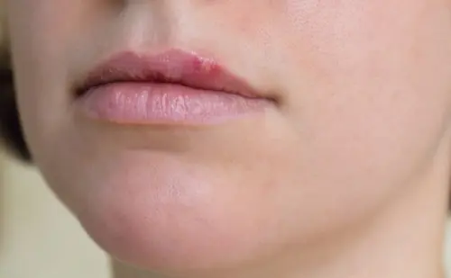 Meno americani contagiati dall'herpes