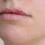 Meno americani contagiati dall'herpes