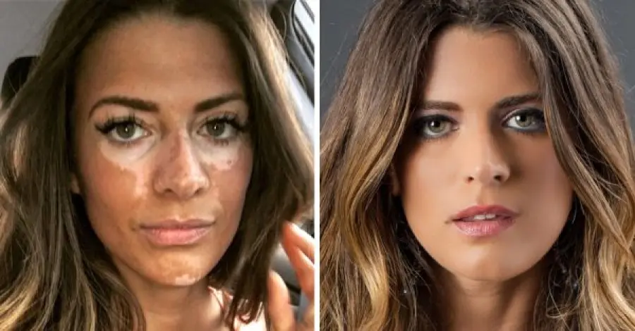 Un nuovo trattamento potrebbe essere una "svolta" per la vitiligine