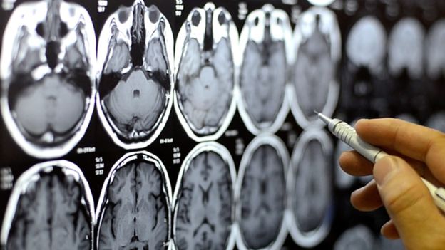 Donazione del cervello stimolata dal centro di ricerca sulla demenza di Cardiff