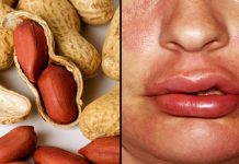 Il trattamento per l'allergia alle arachidi è promettente nello studio