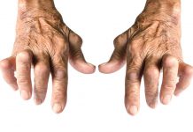 Farmaco reumatoide - Nessun aiuto ai pazienti affetti da artrite