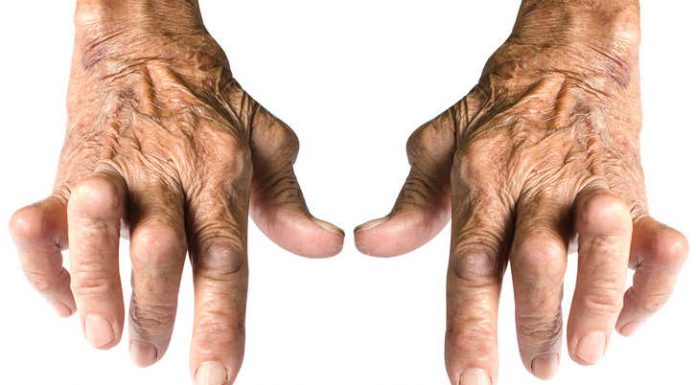 Farmaco reumatoide - Nessun aiuto ai pazienti affetti da artrite