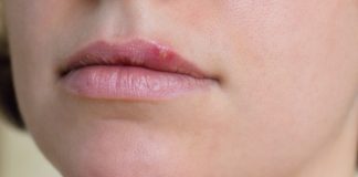 Meno americani contagiati dall'herpes